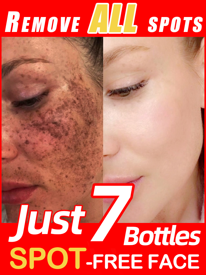 Luxury Skincare Essence - Schiarire le lentiggini Melasma, macchie scure